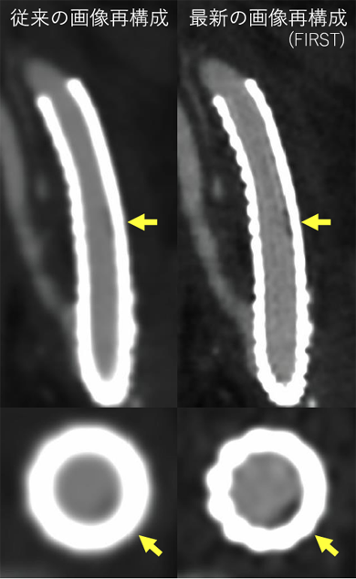 画像：頸動脈ステント内のプラーク評価