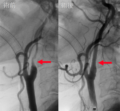 画像：頚動脈ステント留置術