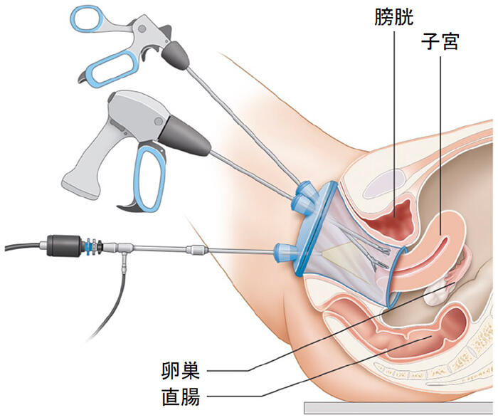 vNOTES手術イメージ図