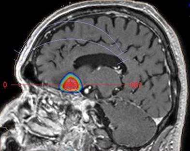 定位放射線治療を実行した転移性脳腫瘍