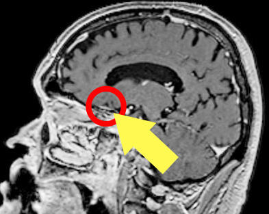 定位放射線治療後の転移性脳腫瘍