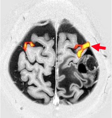 画像：頭部fMRI（右掌握運動）